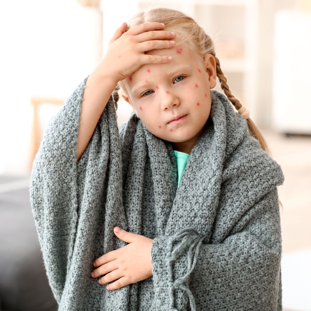a child who has chickenpox wrapped in a blanket