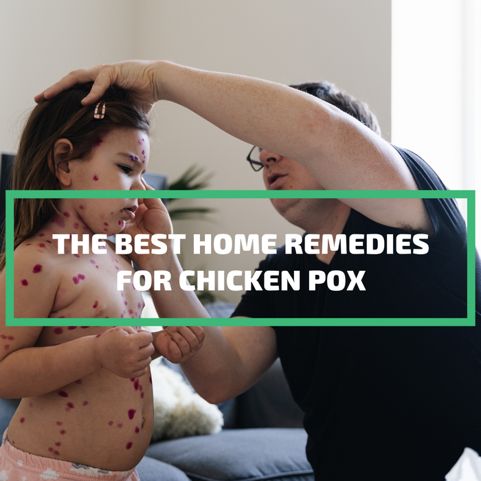 The Best Home Remedies for Chicken Pox