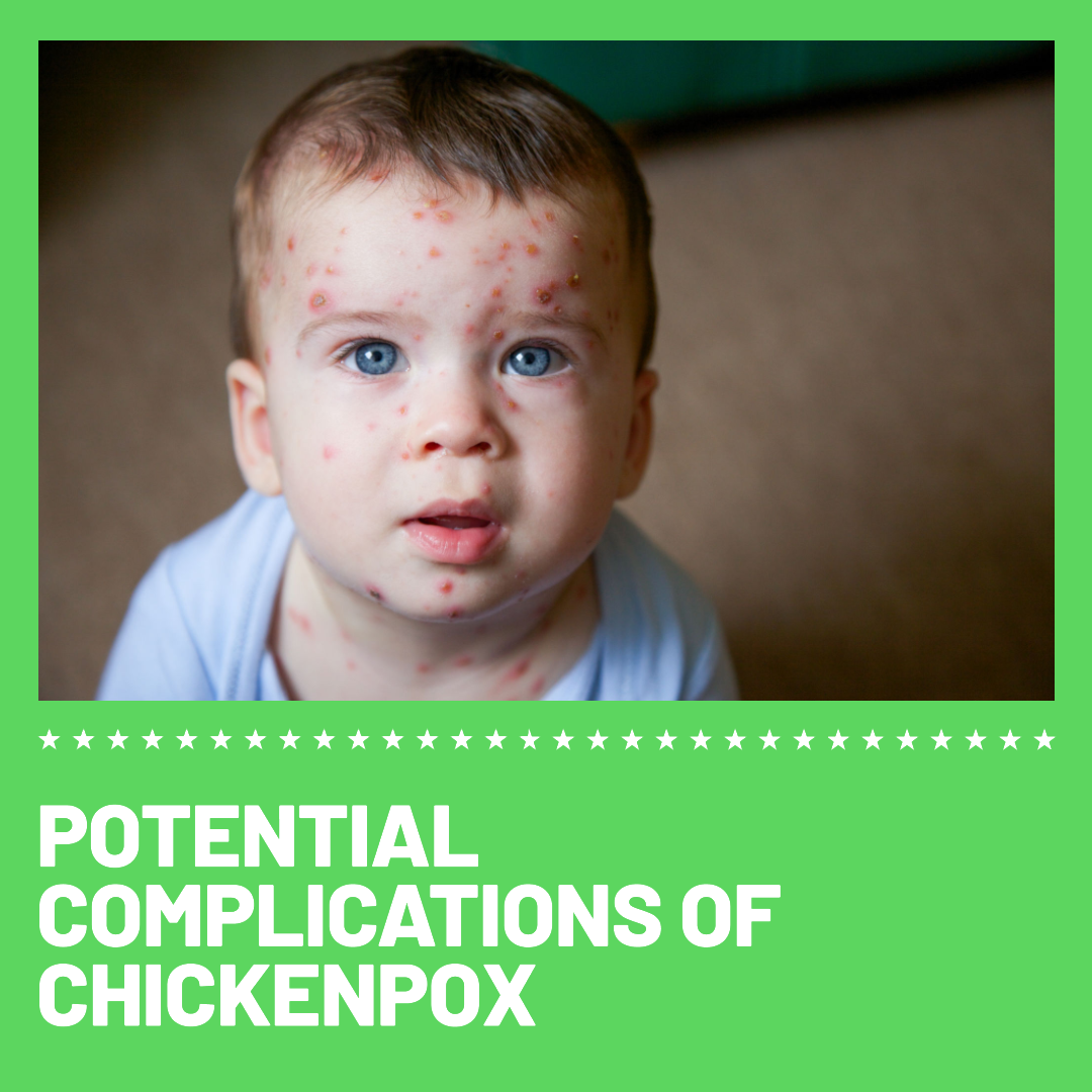 a baby boy with chickenpox looking at the lense - What are the Potential Complications of Chickenpox? 
