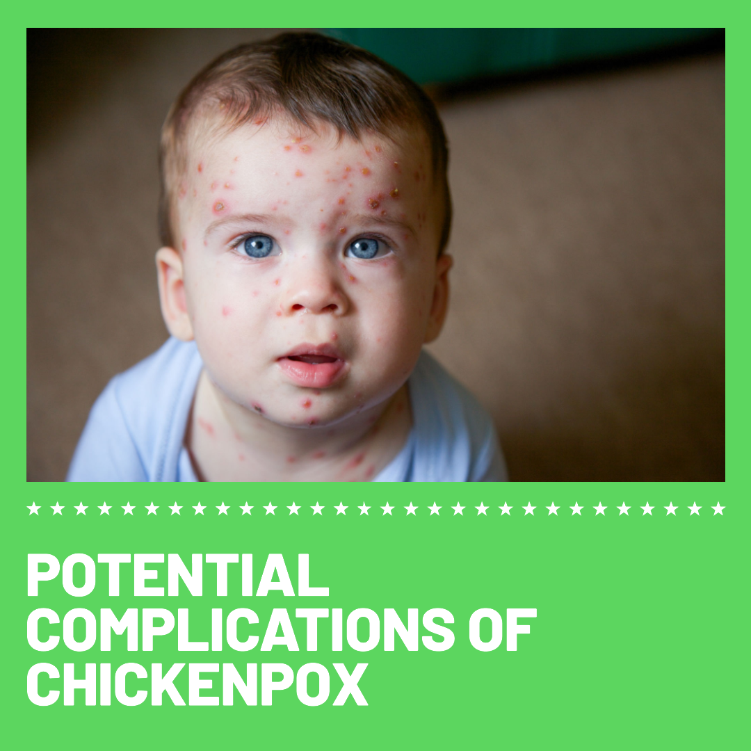 Understanding Chickenpox Potential Complications & Management — RiiRoo