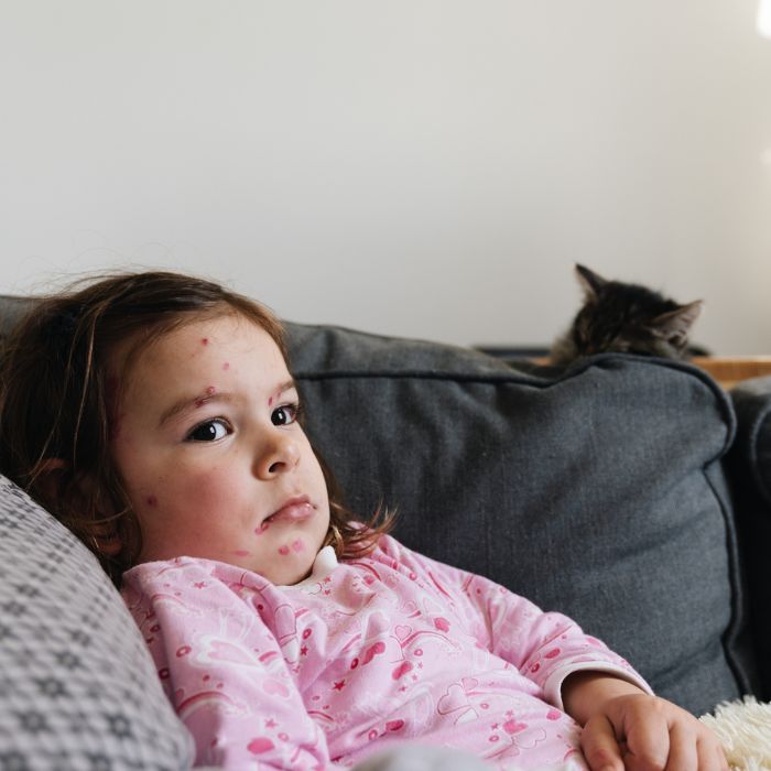 a young girl on the sofa with chicken pox